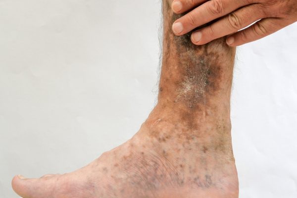 Úlceras-nas-Pernas-O-que-Pode-Estar-por-Trás