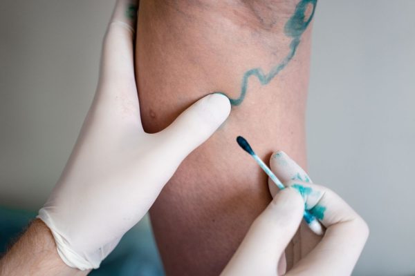 Doença Arterial Periférica